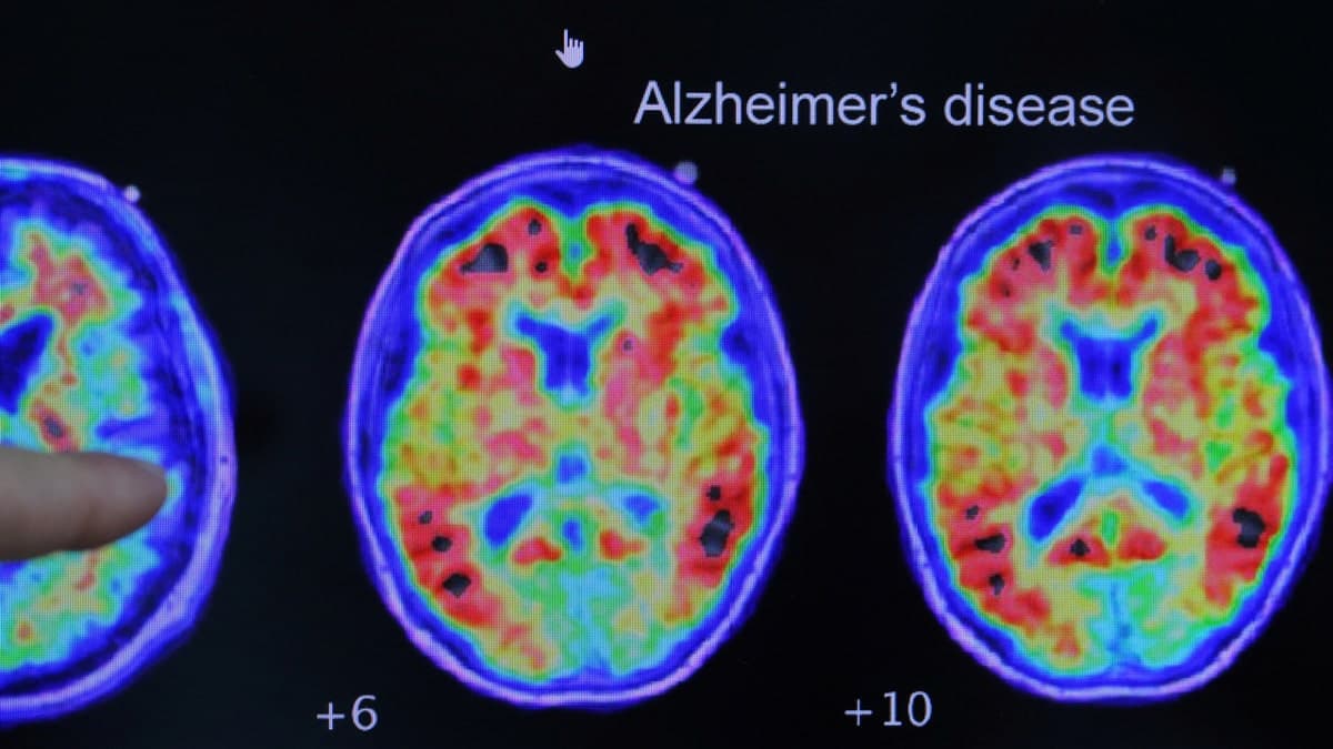The Alzheimer's Epidemic Is Bleeding American Families Dry, And Nobody in Washington Is Counting the Cost